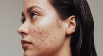 Kulit Acne-Prone? Hati-Hati dengan Sunscreen SPF Tinggi