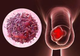 penyakit kanker penis