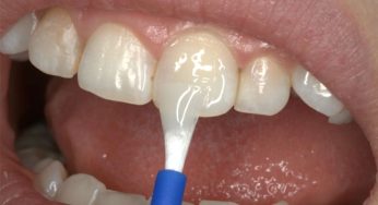 Rahasia Gigi Tahan Karies dengan Topikal Fluoride