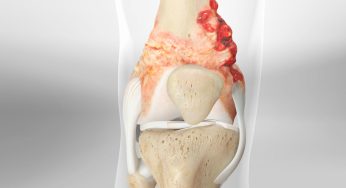 Nyeri Kaki Tak Sembuh-sembuh? Hati-hati, Bisa Jadi Gejala Kanker Tulang