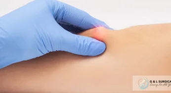 Lipoma vs Kista: Cara Membedakan Benjolan Lemak Jinak di Tangan